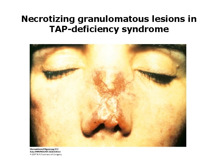 Necrotizing granulomatous lesions in TAP-deficiency syndrome 
