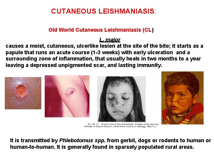 CUTANEOUS LEISHMANIASIS: Old World Cutaneous Leishmaniasis (CL) L. major causes a moist, cutaneous, ulcerlike