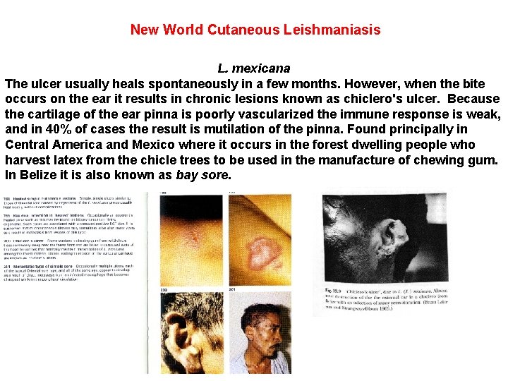 New World Cutaneous Leishmaniasis L. mexicana The ulcer usually heals spontaneously in a few
