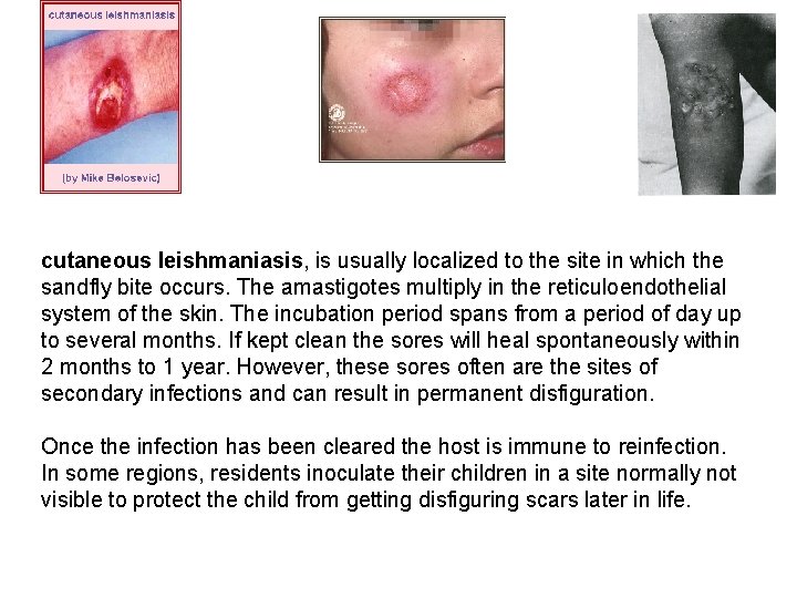 cutaneous leishmaniasis, is usually localized to the site in which the sandfly bite occurs.