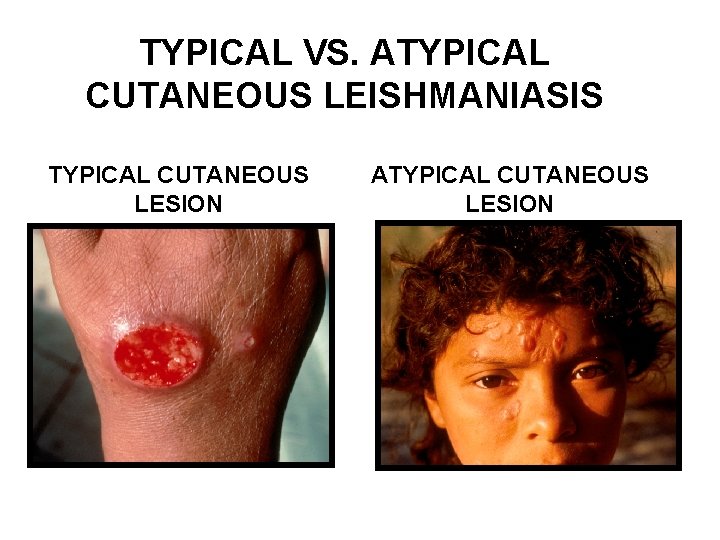 TYPICAL VS. ATYPICAL CUTANEOUS LEISHMANIASIS TYPICAL CUTANEOUS LESION ATYPICAL CUTANEOUS LESION 