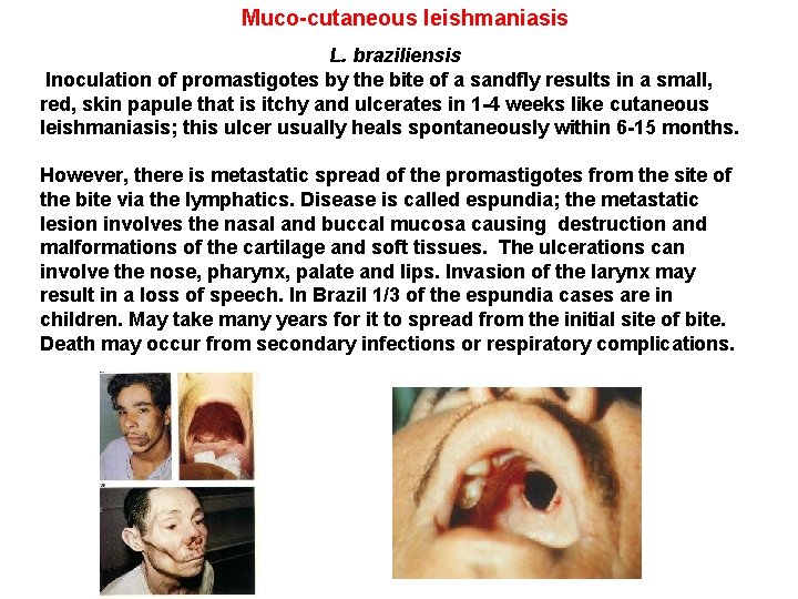 Muco-cutaneous leishmaniasis L. braziliensis Inoculation of promastigotes by the bite of a sandfly results