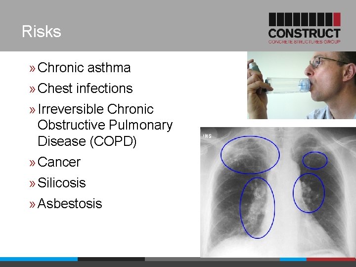 Risks » Chronic asthma » Chest infections » Irreversible Chronic Obstructive Pulmonary Disease (COPD)