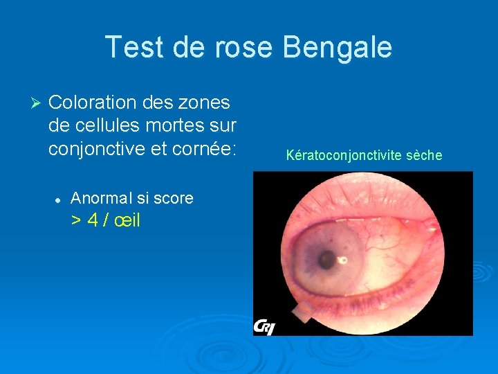 Test de rose Bengale Ø Coloration des zones de cellules mortes sur conjonctive et