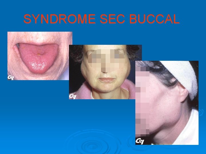 SYNDROME SEC BUCCAL 