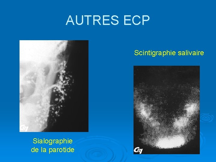 AUTRES ECP Scintigraphie salivaire Sialographie de la parotide 