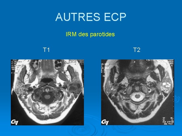 AUTRES ECP IRM des parotides T 1 T 2 