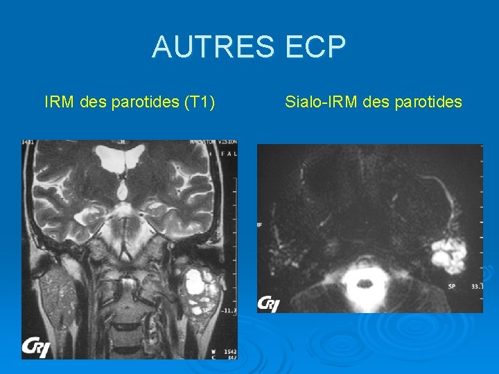 AUTRES ECP IRM des parotides (T 1) Sialo-IRM des parotides 