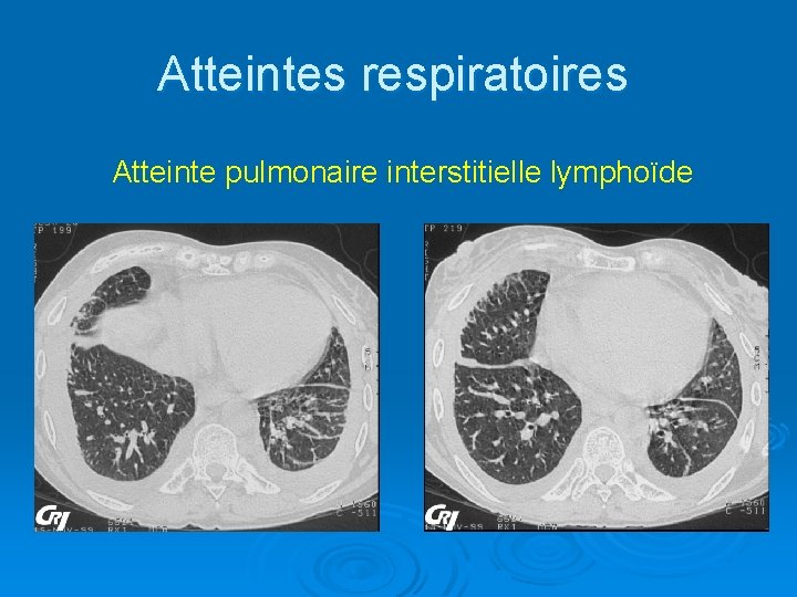 Atteintes respiratoires Atteinte pulmonaire interstitielle lymphoïde 