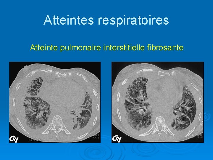 Atteintes respiratoires Atteinte pulmonaire interstitielle fibrosante 