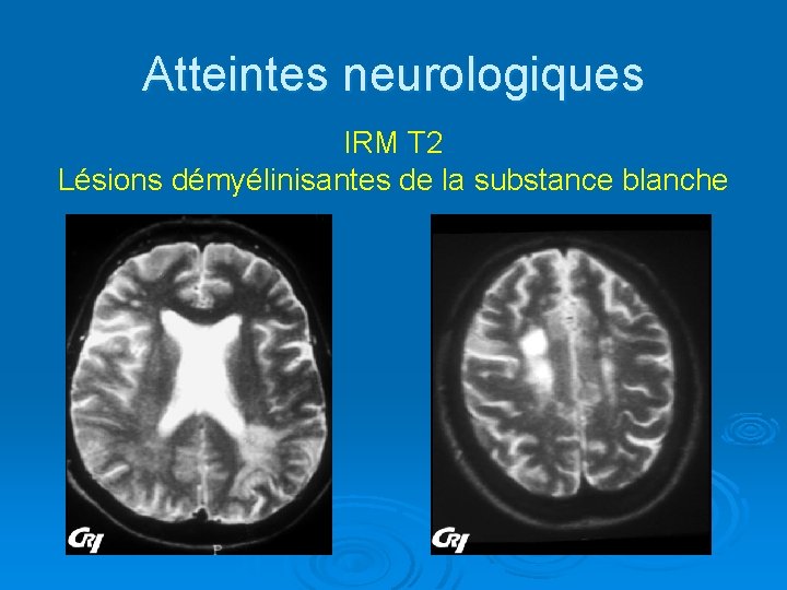 Atteintes neurologiques IRM T 2 Lésions démyélinisantes de la substance blanche 