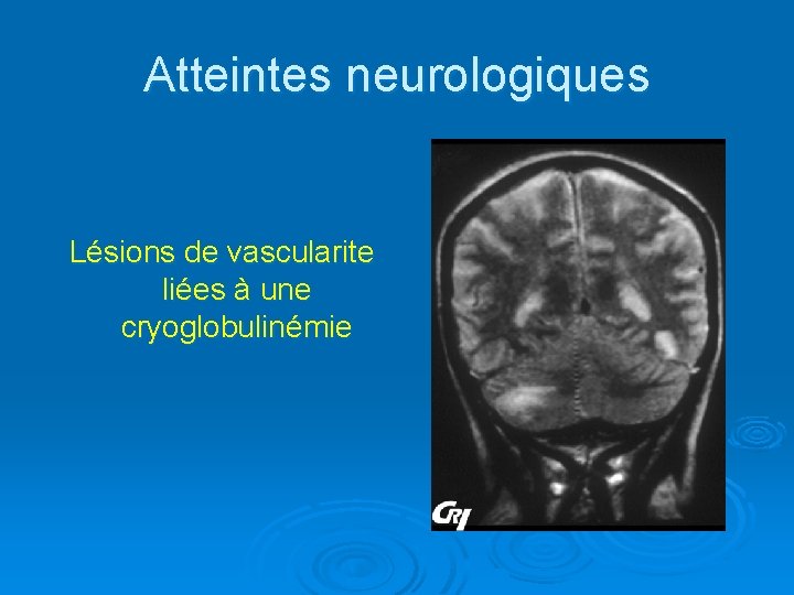 Atteintes neurologiques Lésions de vascularite liées à une cryoglobulinémie 