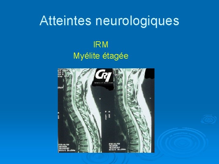 Atteintes neurologiques IRM Myélite étagée 