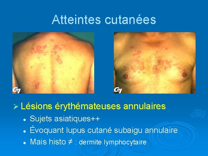 Atteintes cutanées Ø Lésions érythémateuses annulaires l l l Sujets asiatiques++ Évoquant lupus cutané