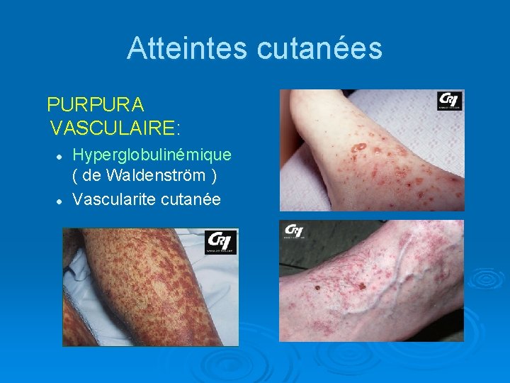 Atteintes cutanées PURPURA VASCULAIRE: l l Hyperglobulinémique ( de Waldenström ) Vascularite cutanée 