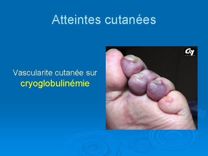 Atteintes cutanées Vascularite cutanée sur cryoglobulinémie 