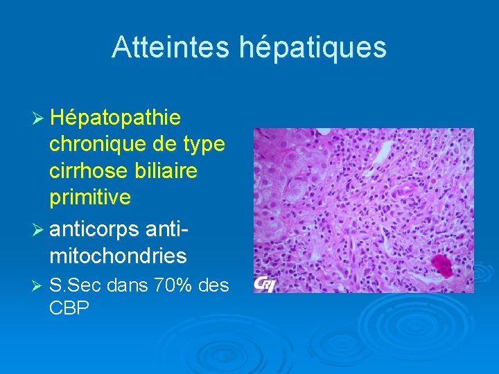 Atteintes hépatiques Ø Hépatopathie chronique de type cirrhose biliaire primitive Ø anticorps antimitochondries Ø
