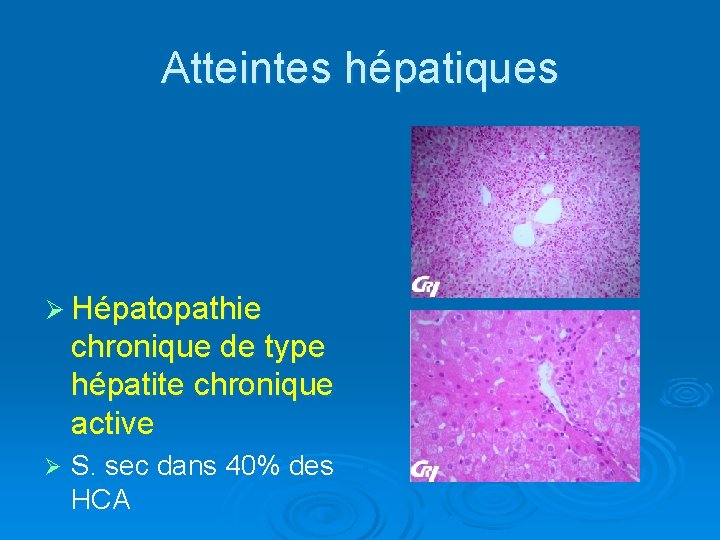 Atteintes hépatiques Ø Hépatopathie chronique de type hépatite chronique active Ø S. sec dans