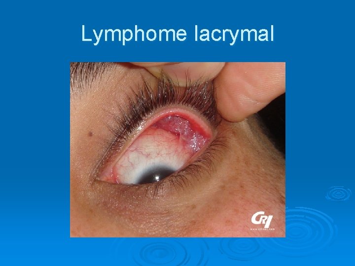 Lymphome lacrymal 