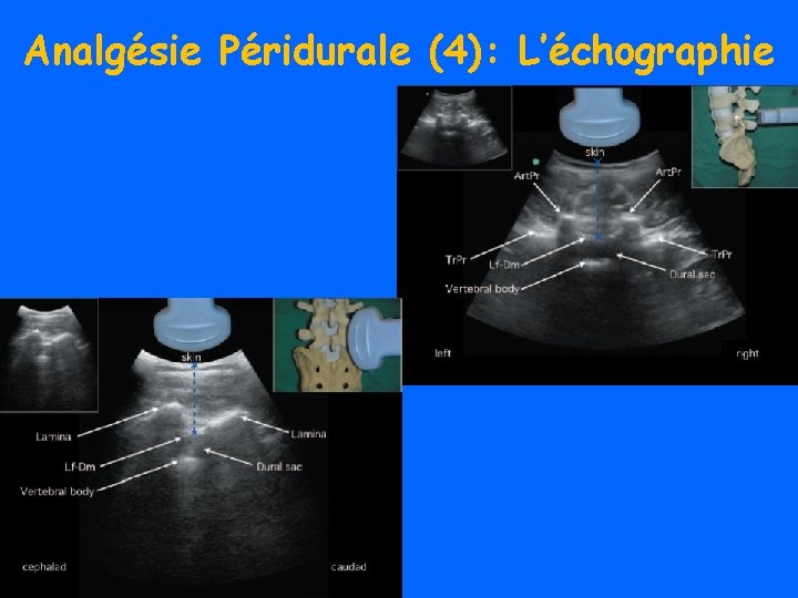 Analgésie Péridurale (4): L’échographie 