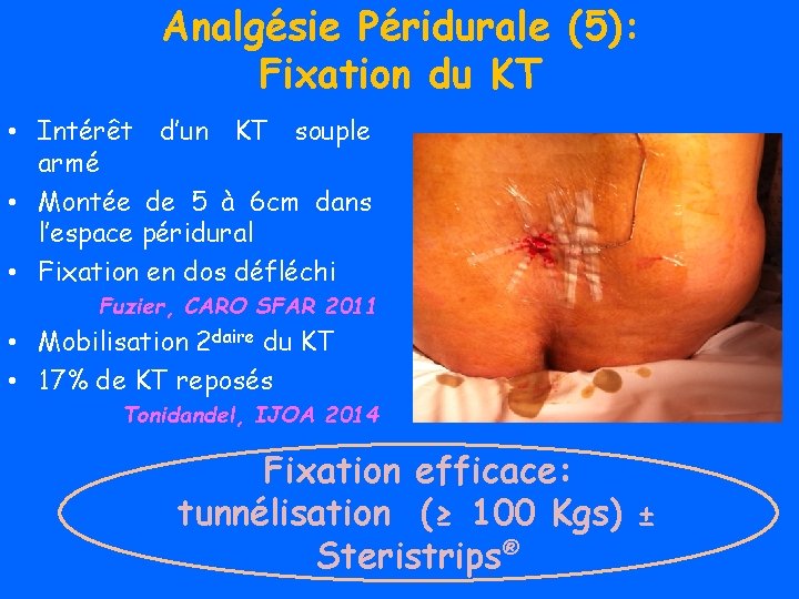 Analgésie Péridurale (5): Fixation du KT • Intérêt d’un KT souple armé • Montée