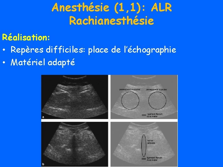 Anesthésie (1, 1): ALR Rachianesthésie Réalisation: • Repères difficiles: place de l’échographie • Matériel