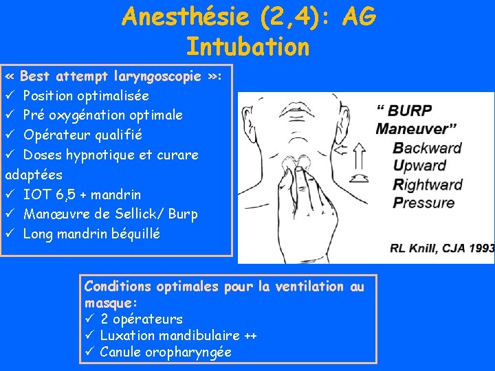 Anesthésie (2, 4): AG Intubation « Best attempt laryngoscopie » : ü Position optimalisée