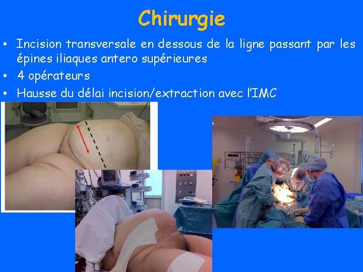 Chirurgie • Incision transversale en dessous de la ligne passant par les épines iliaques