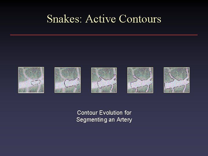 Snakes: Active Contours Contour Evolution for Segmenting an Artery 