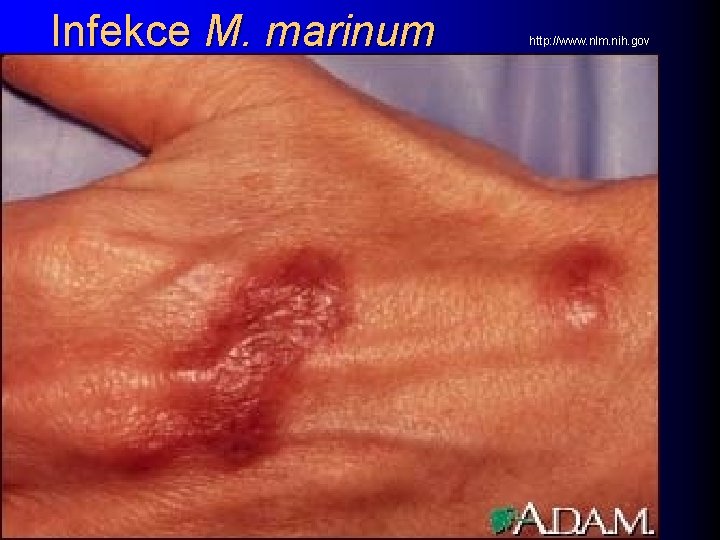 Infekce M. marinum http: //www. nlm. nih. gov 