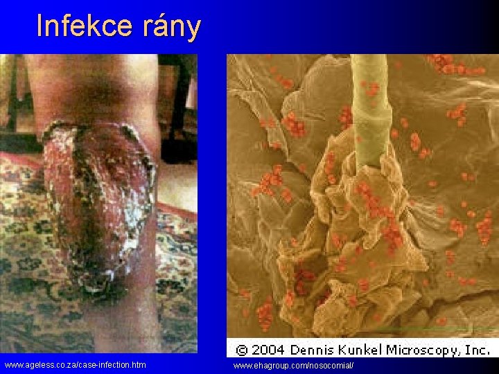 Infekce rány www. ageless. co. za/case-infection. htm www. ehagroup. com/nosocomial/ 