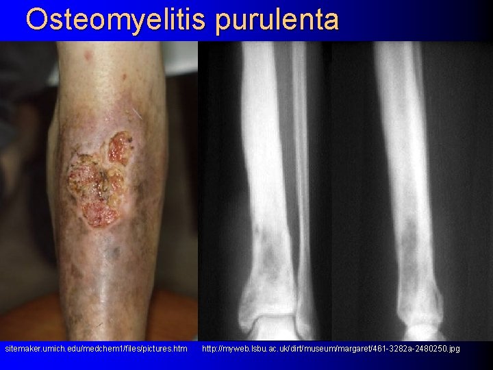 Osteomyelitis purulenta sitemaker. umich. edu/medchem 1/files/pictures. htm http: //myweb. lsbu. ac. uk/dirt/museum/margaret/461 -3282 a-2480250.