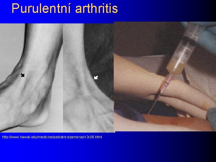 Purulentní arthritis http: //www. hawaii. edu/medicine/pediatrics/pemxray/v 3 c 06. html 