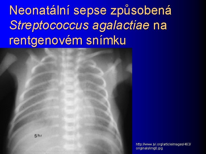 Neonatální sepse způsobená Streptococcus agalactiae na rentgenovém snímku http: //www. jyi. org/articleimages/463/ originals/img 0.