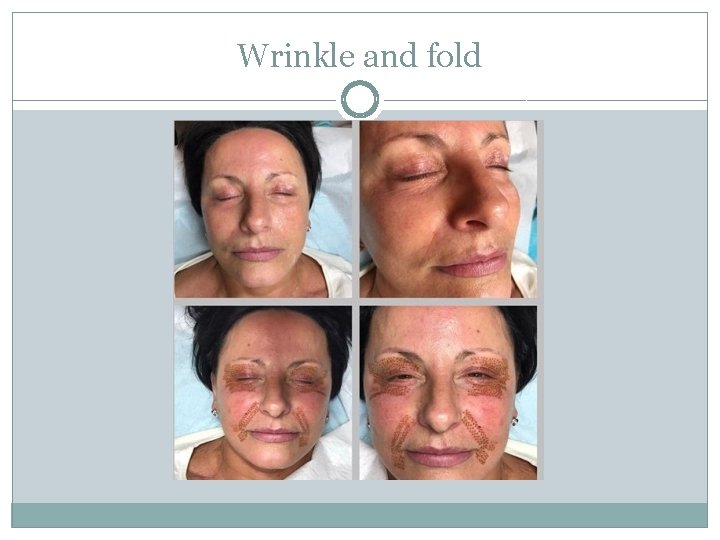 Wrinkle and fold 