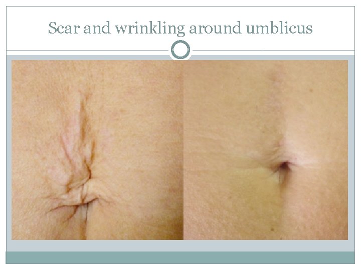 Scar and wrinkling around umblicus 