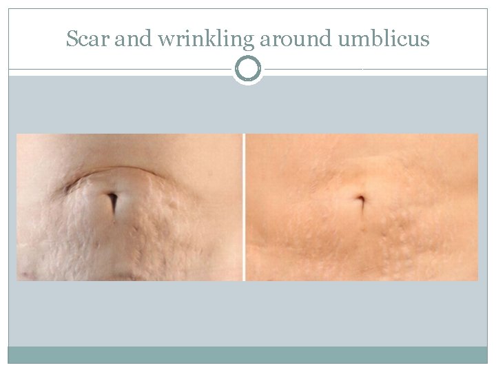 Scar and wrinkling around umblicus 