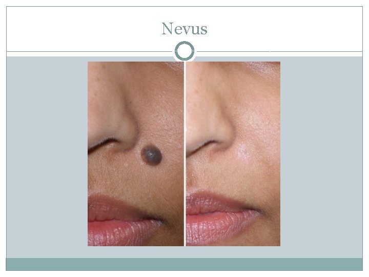 Nevus 