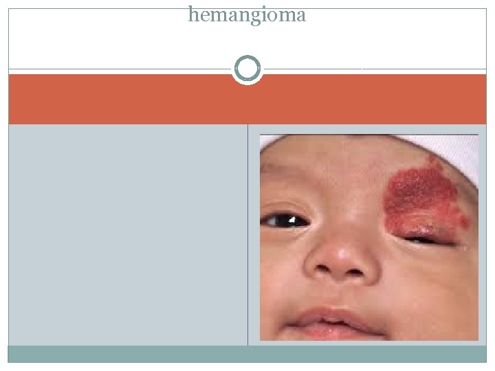 hemangioma 