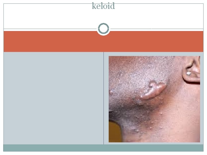 keloid 