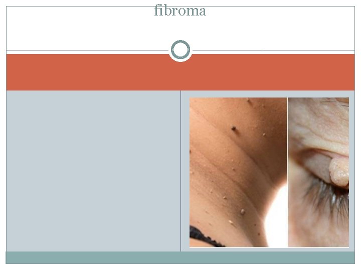 fibroma 