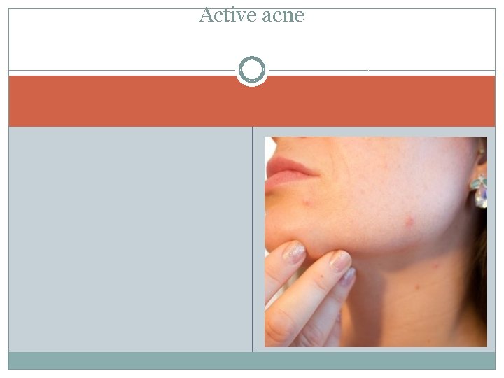 Active acne 