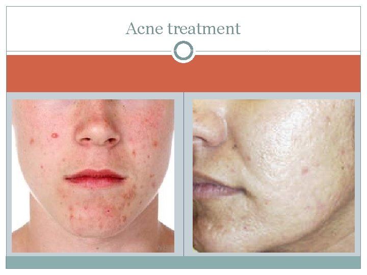 Acne treatment 