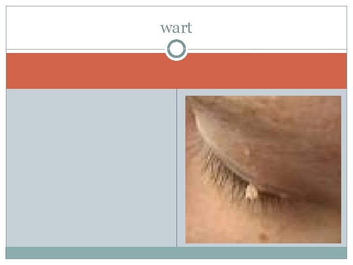 wart 