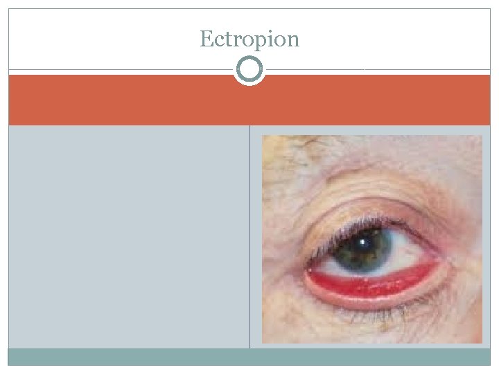 Ectropion 