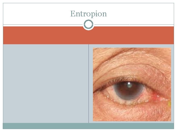 Entropion 
