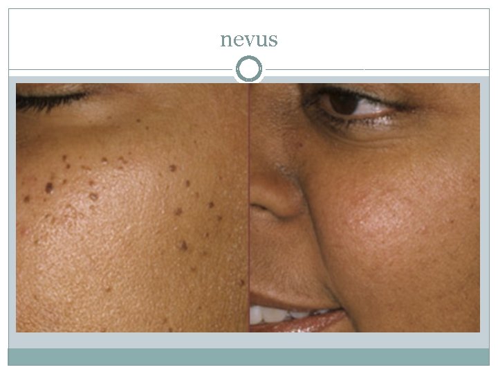 nevus 