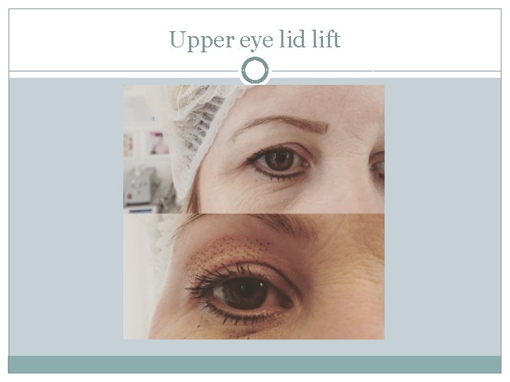 Upper eye lid lift 