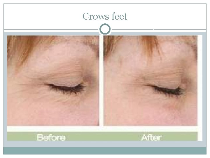 Crows feet 