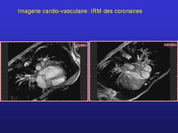 Imagerie cardio-vasculaire: IRM des coronaires 